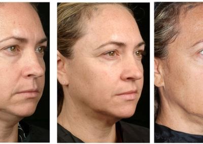 Thermage: reduce flaccidity in a single session