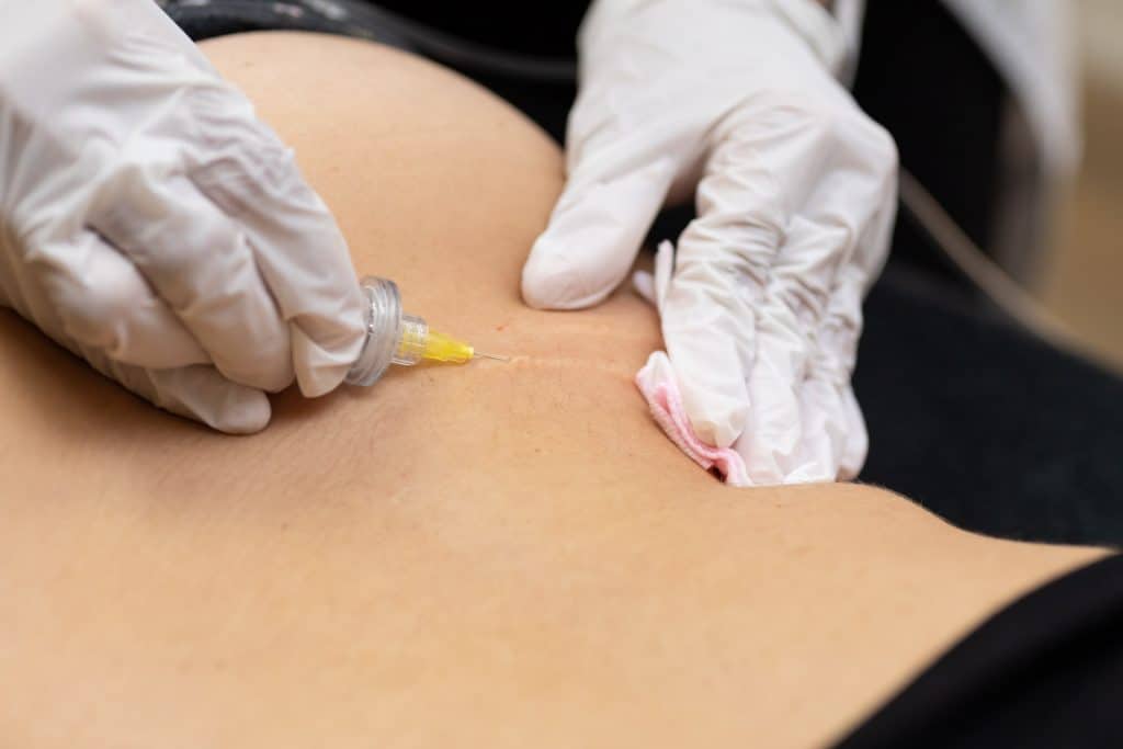 Evolución en celulitis fibrosa y estrías